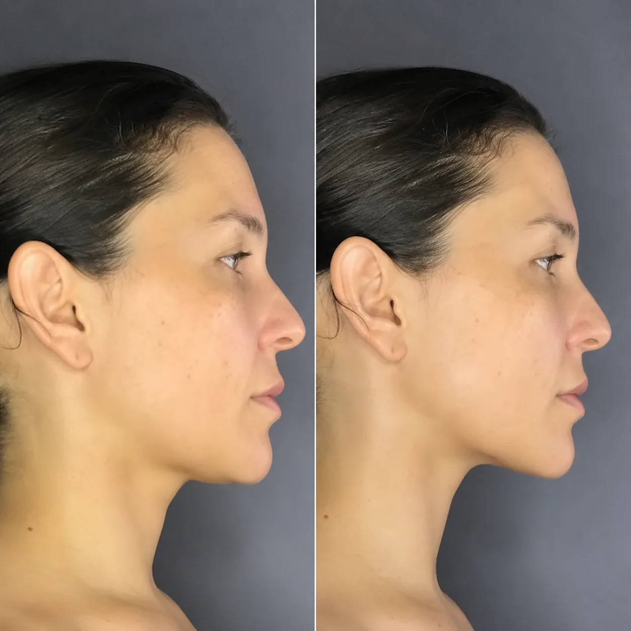 Comparação de acompanhamento facial antes e depois — registro 2